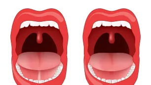 Tongue-Tie and Breastfeeding: What Every Parent and Professional Needs to Know