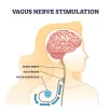 cpd-Parasym-Vagus-Nerve-Stimulation